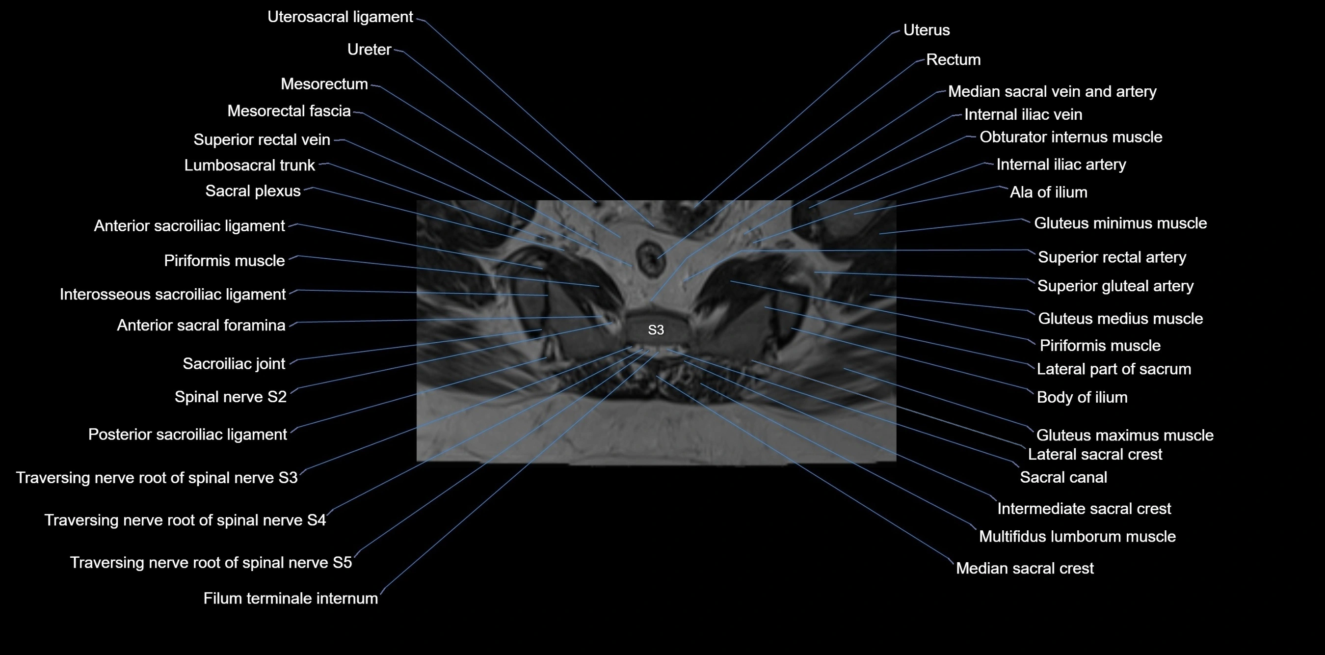 MRI sacrum, coccyx and sacroiliac joint axial cross sectional anatomy 3T  radiology  image-img-00001-00035.webp